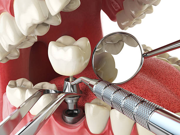 Best Emergency Tooth Extraction in Fitchburg, MA